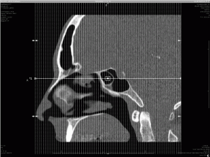 Coronal-CT-Scan-Slices If my head went through a cheese grater, it might look like this.