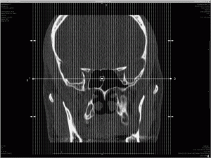 Saggital Slices 300x225   Inside My Head 3   Sagittal CT Scan