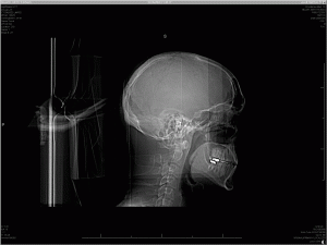 X-ray of my head - side view X-ray of my head - side view